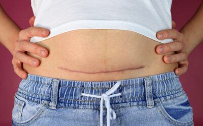 Why Does My Scar Hurt? Weather?