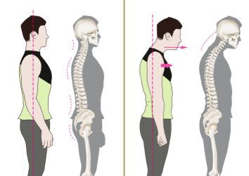 Forward Head Posture