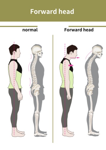 Forward Head Posture