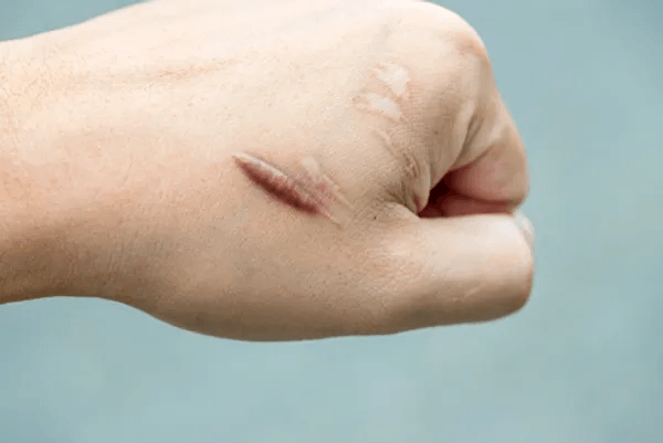 hand scar