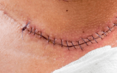 Why Does My Scar Hurt? Nerve Damage