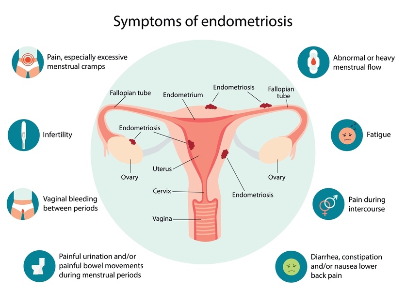 Endometriosis,Symptoms,Infographic.,Detailed,Vector,Infographic.,Women,Health