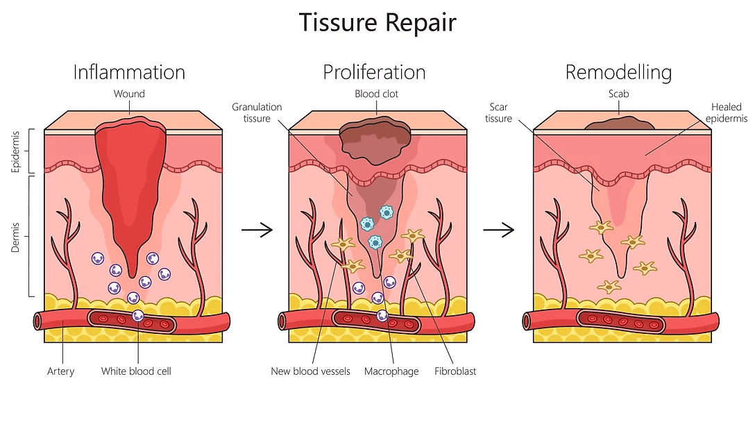 tissue repair